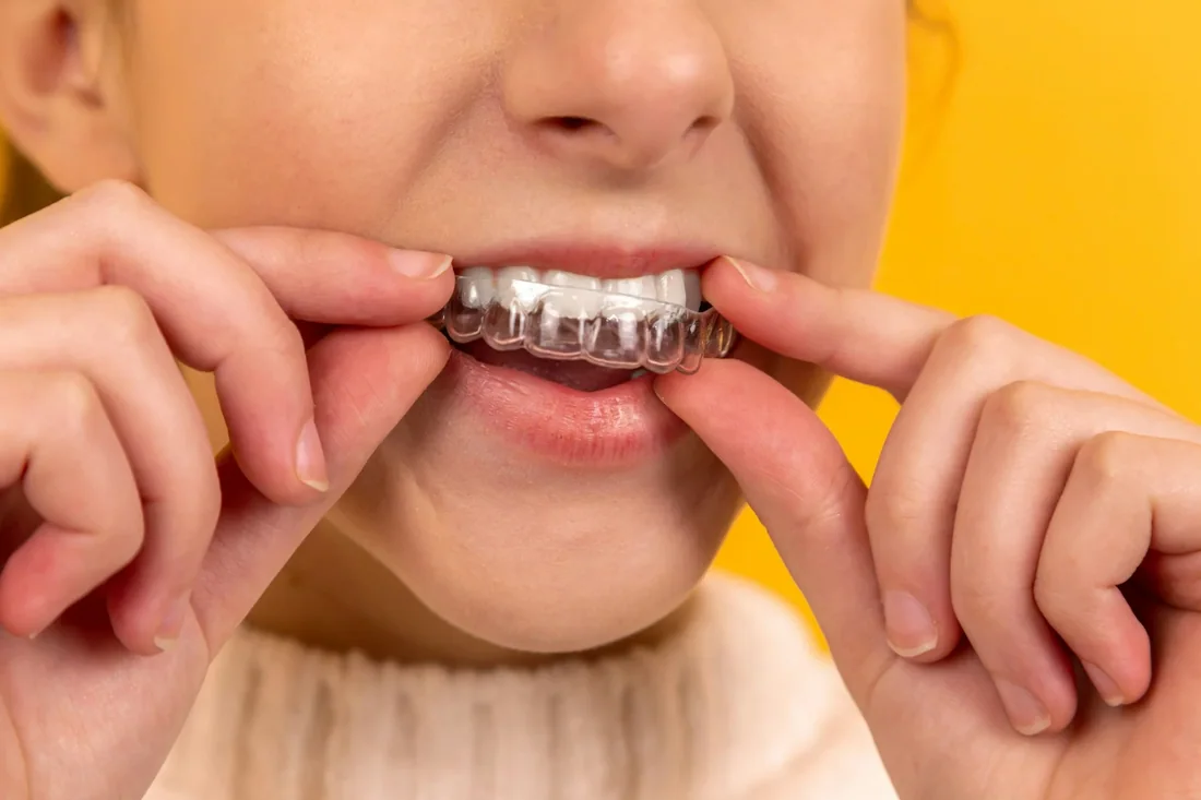 Tư vấn niềng răng chỉnh nha