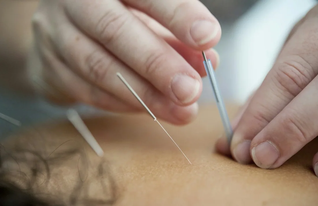 Châm cứu theo phác đồ
